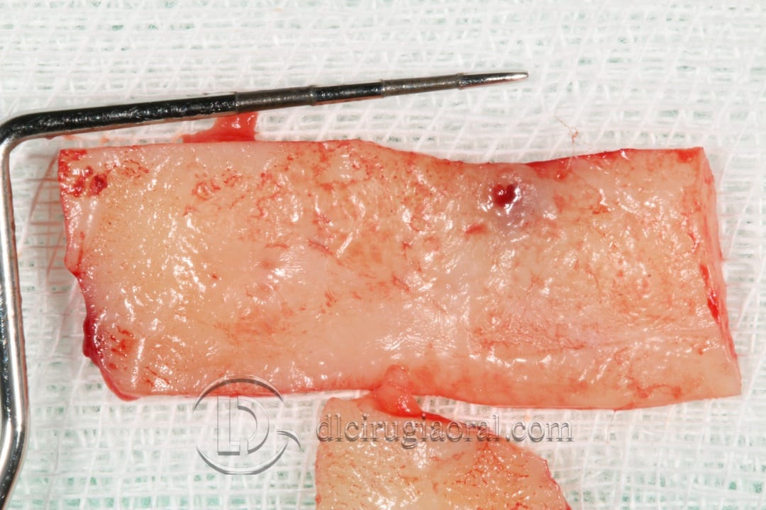 lower overdenture soft tissue improvement