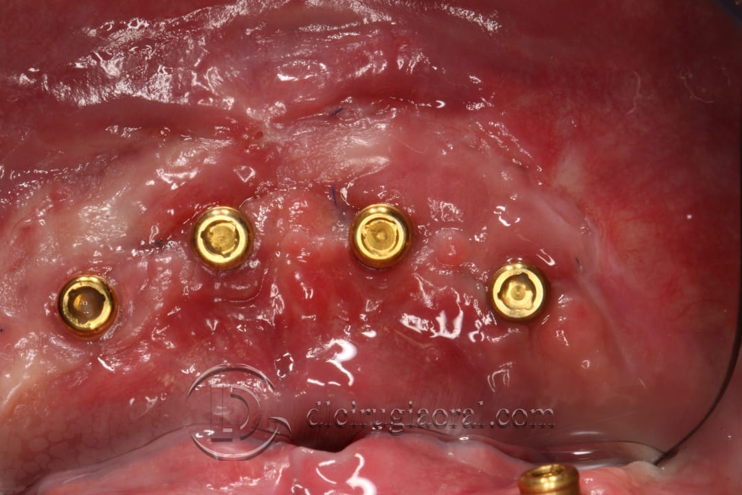lower overdenture soft tissue improvement