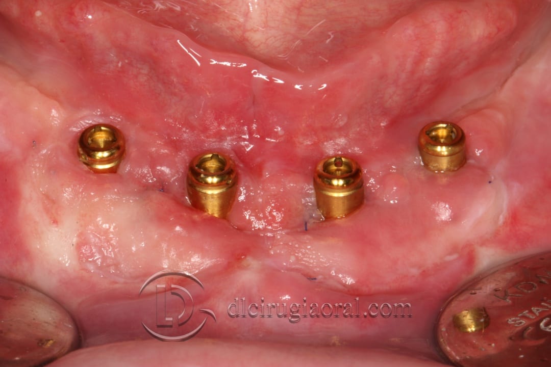 lower overdenture soft tissue improvement