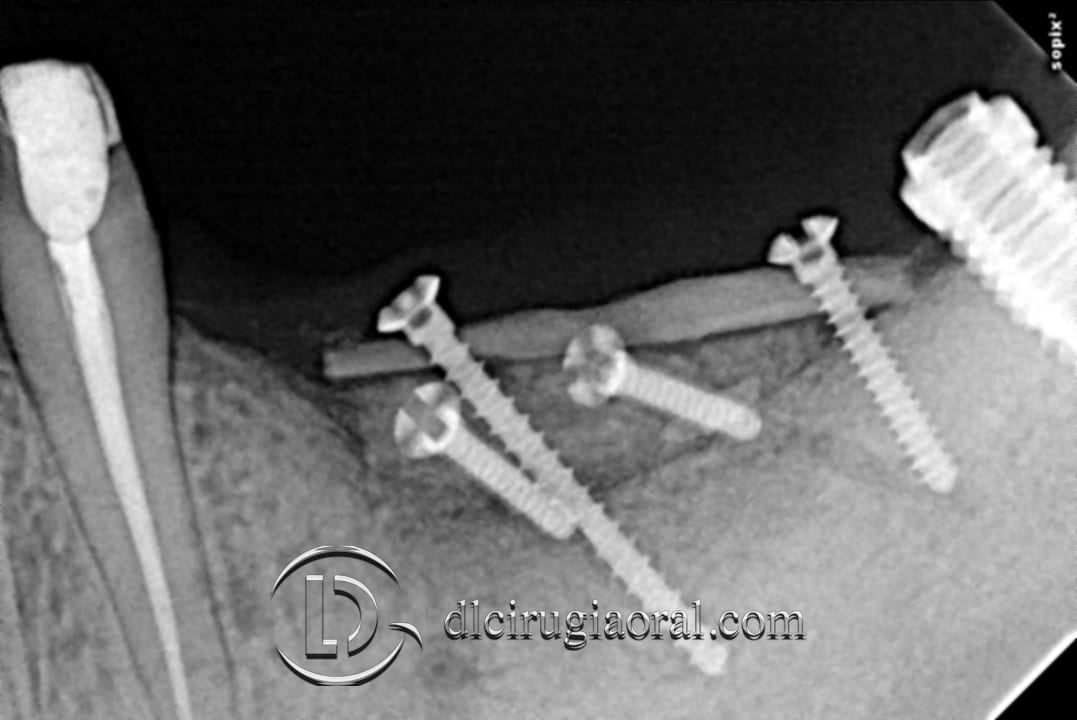 Post-graft x-ray