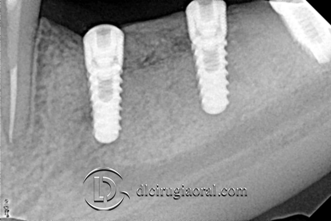 Situation 3 months after placement of implants