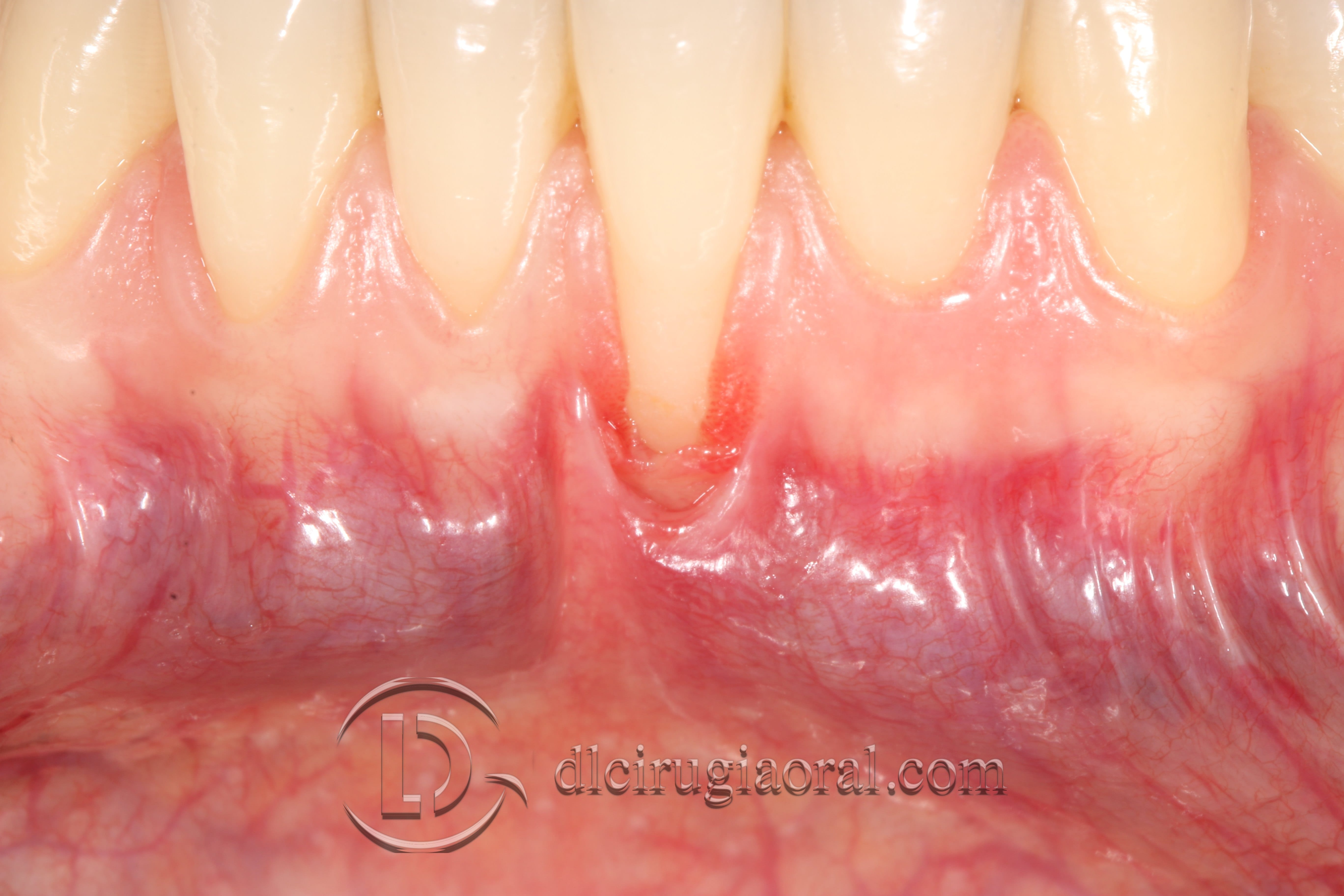 Covering Recessions After Orthodontics