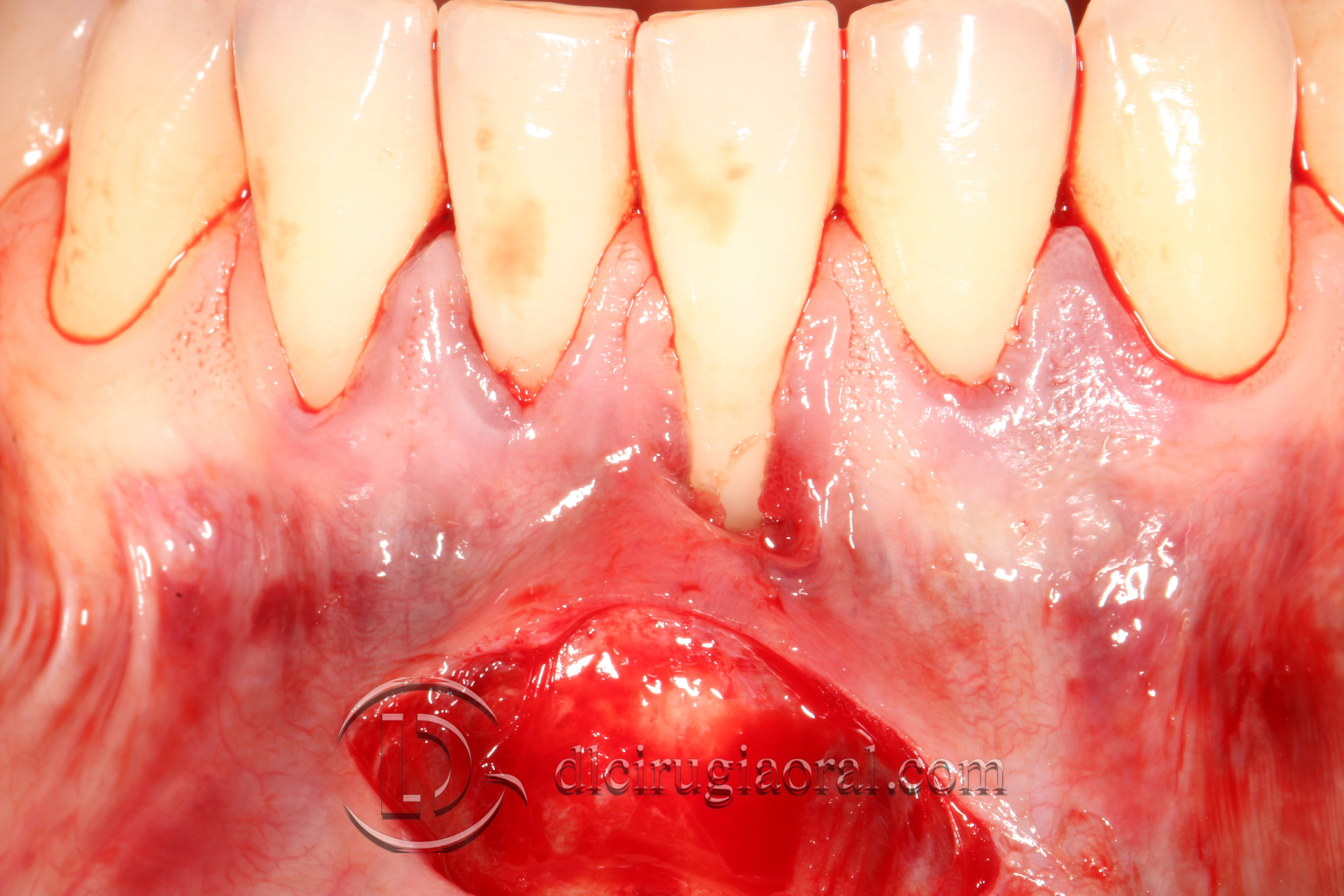 covering recessions after orthodontics
