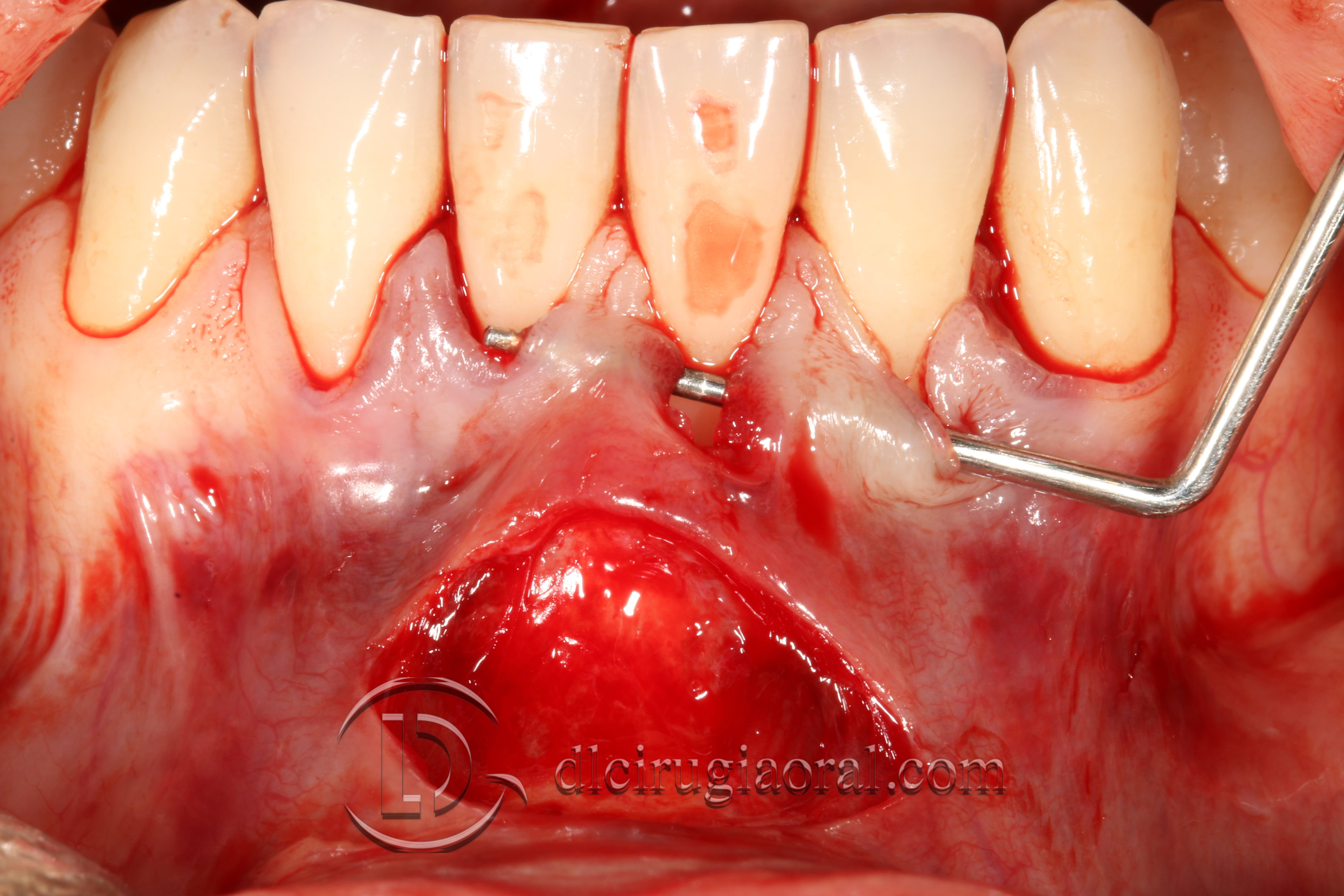 covering recessions after orthodontics