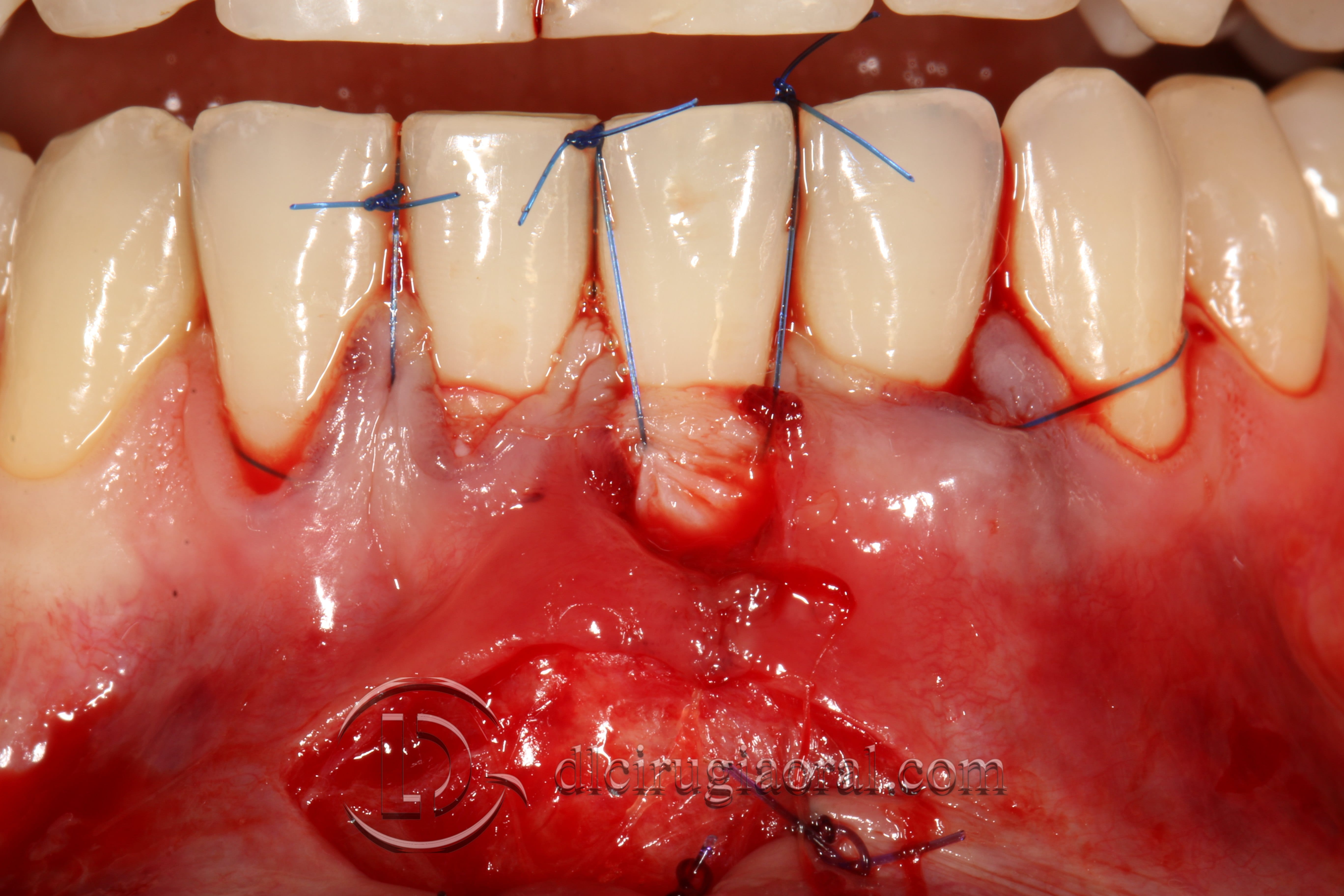 covering recessions after orthodontics