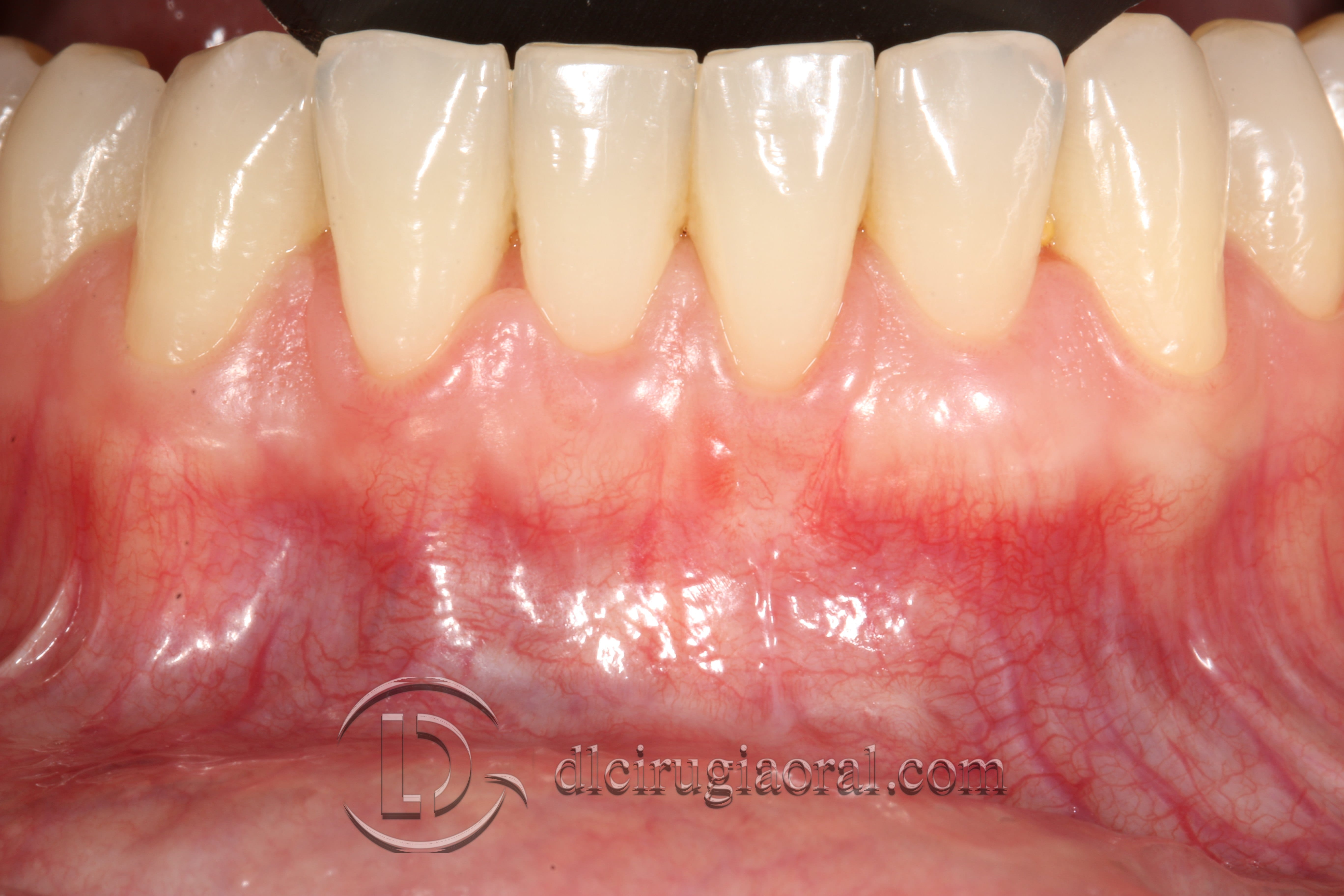 covering recessions after orthodontics