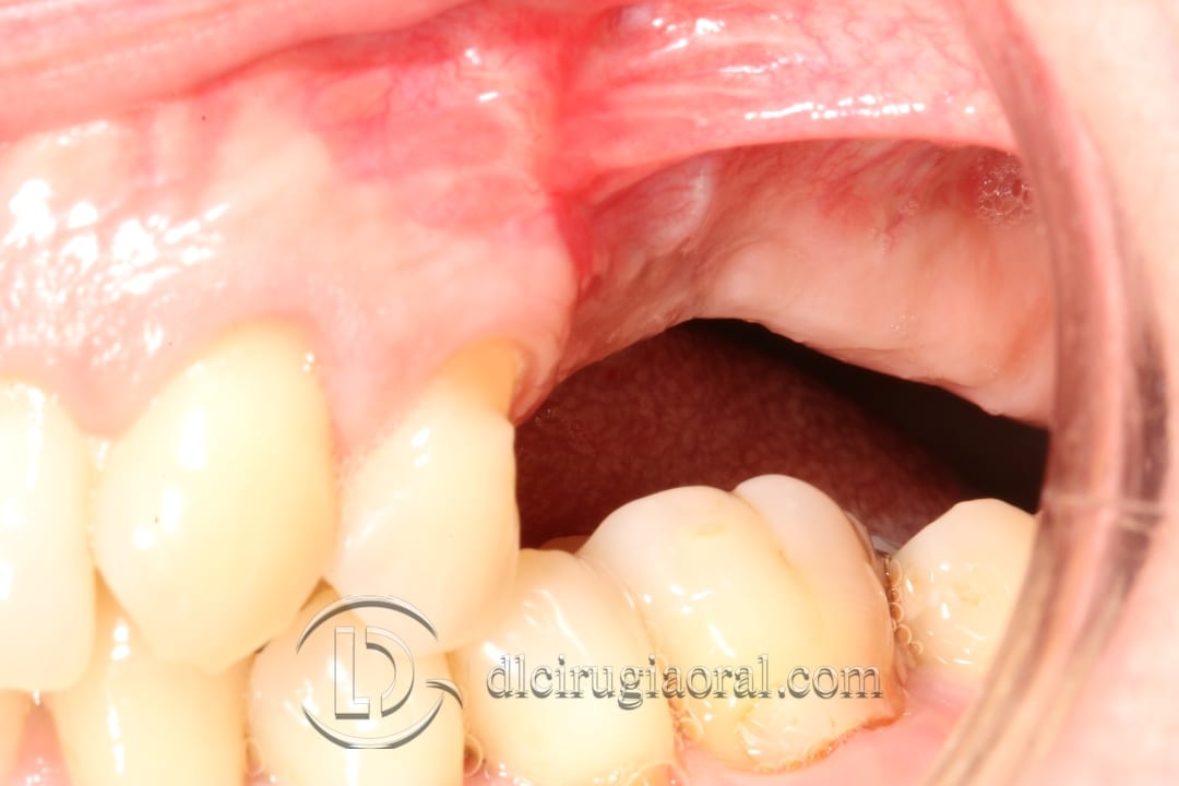 regeneration and sinus lift surgery
