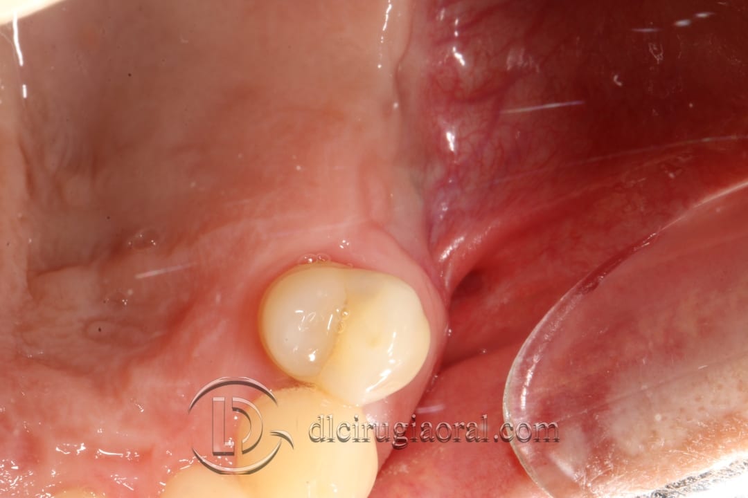 regeneration and sinus lift surgery