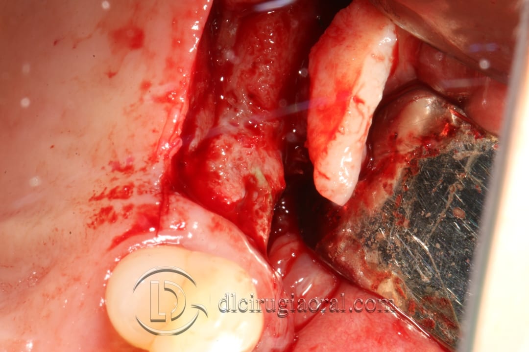 regeneration and sinus lift surgery