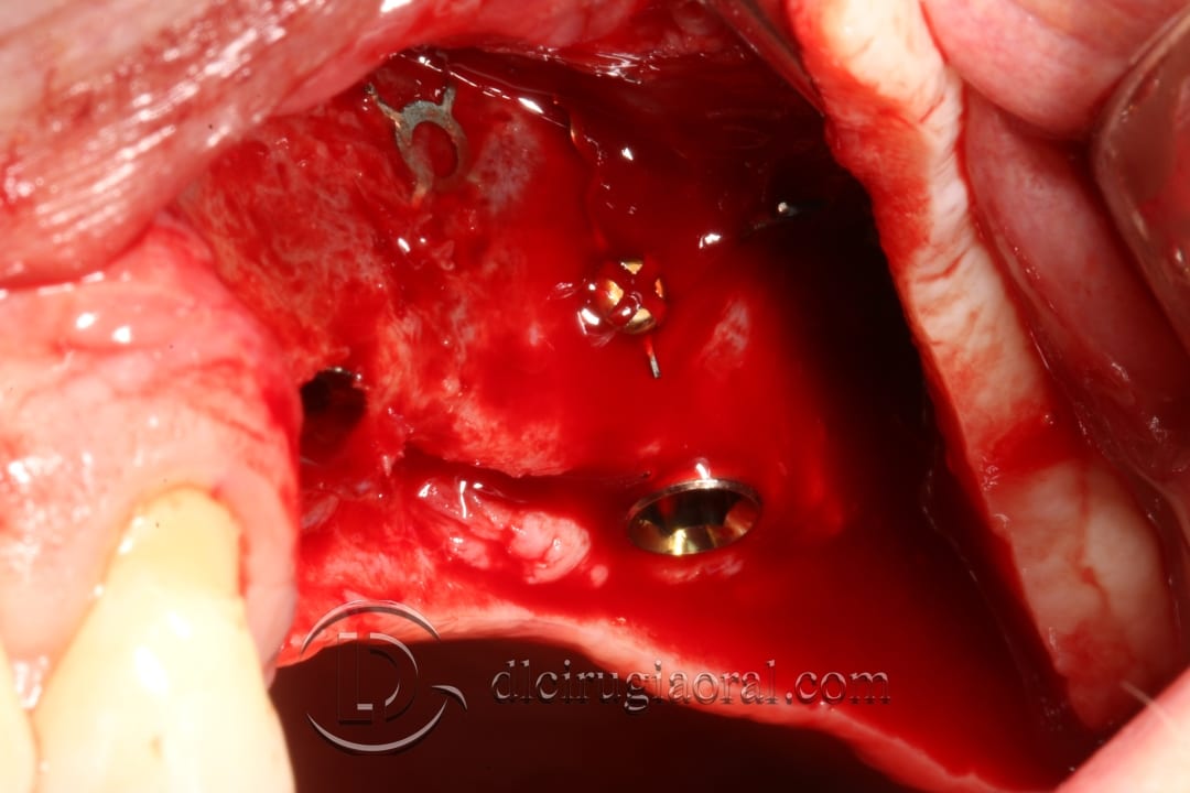 Follow-up of Regeneration and sinus lift surgery