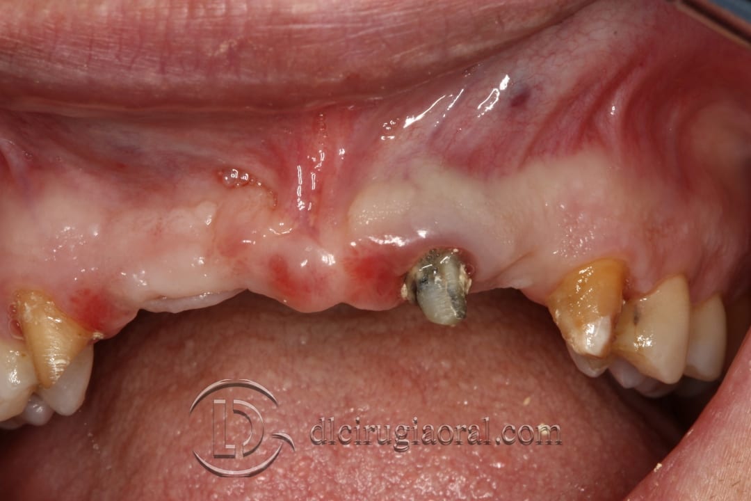 bone reconstruction anterior maxillary section