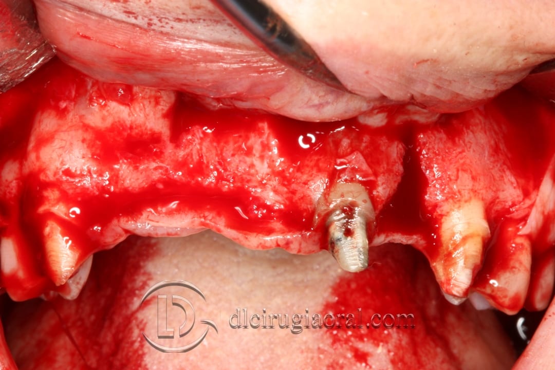 Bone reconstruction in the anterior maxillary section