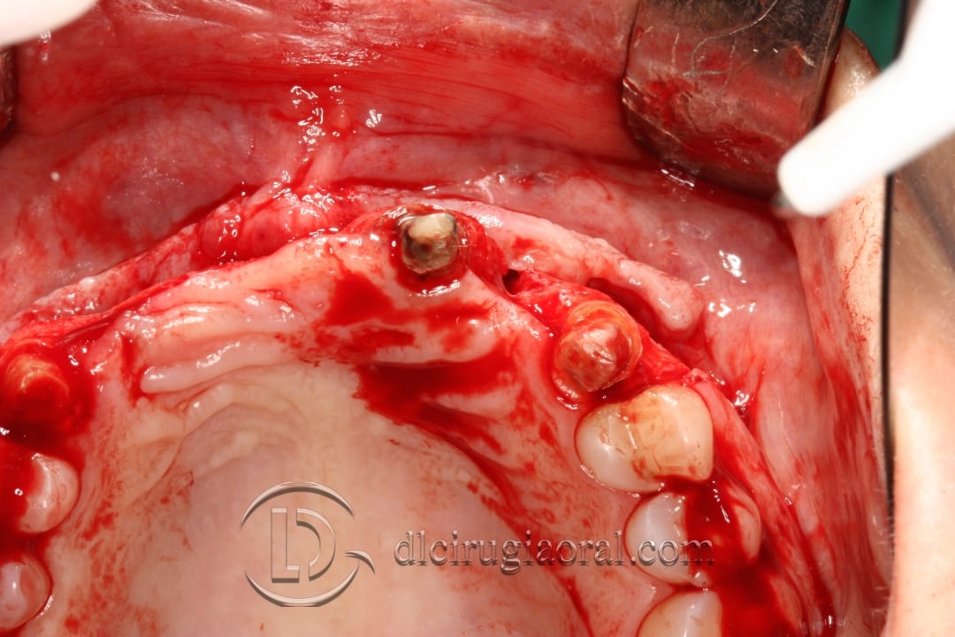 implant placement after anterior bone reconstruction