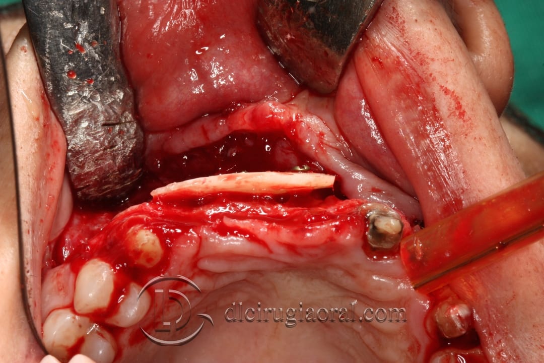 implant placement after anterior bone reconstruction