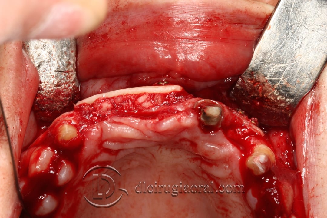 implant placement after anterior bone reconstruction