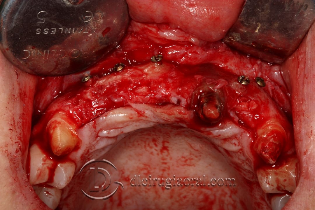 bone reconstruction anterior maxillary section
