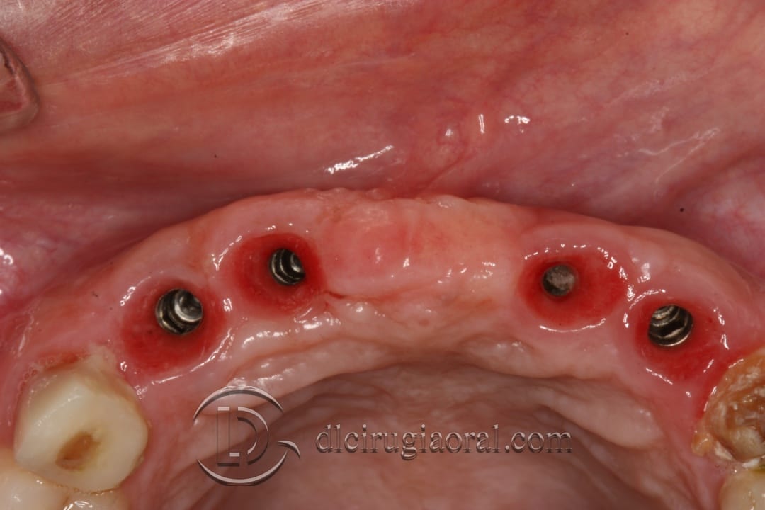 implant placement after anterior bone reconstruction