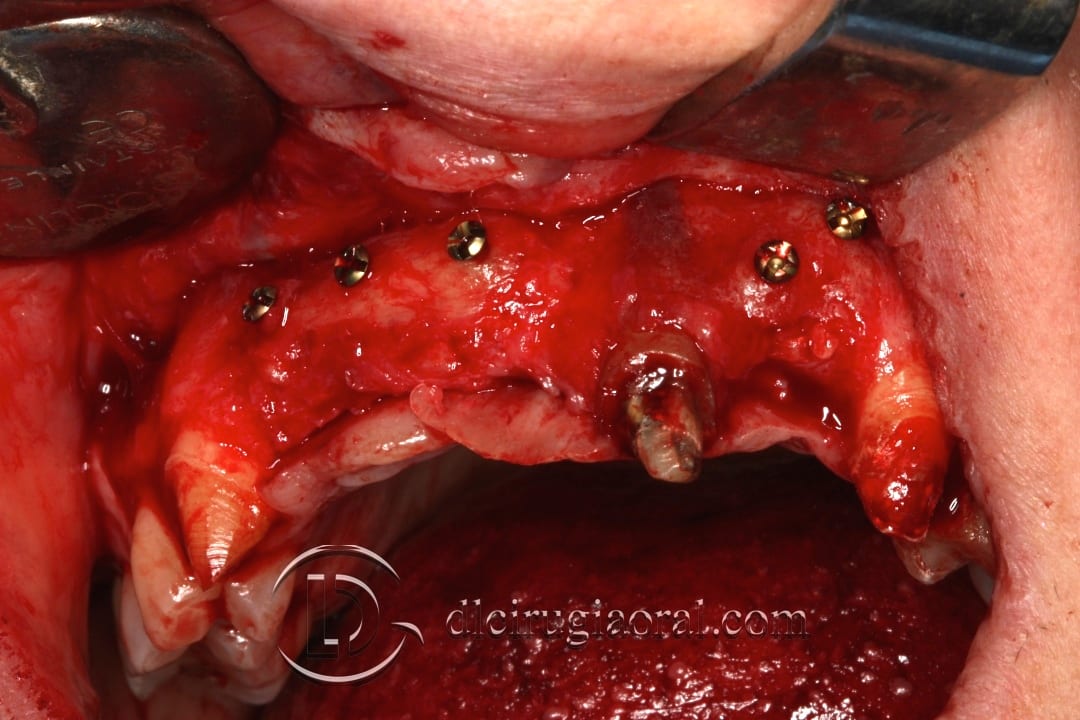 Implant placement after anterior bone reconstruction