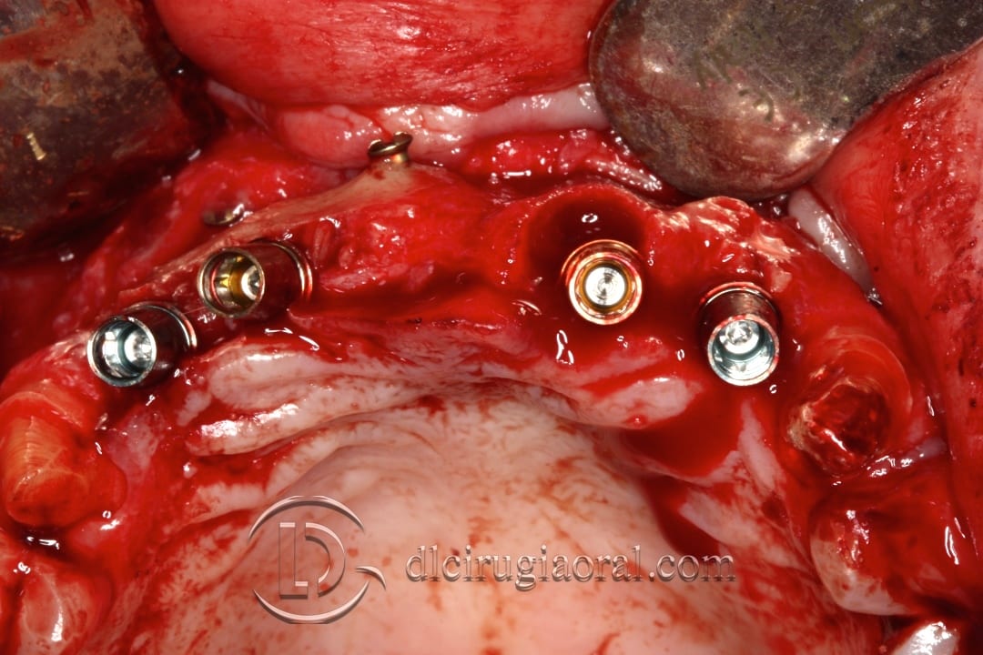 implant placement after anterior bone reconstruction