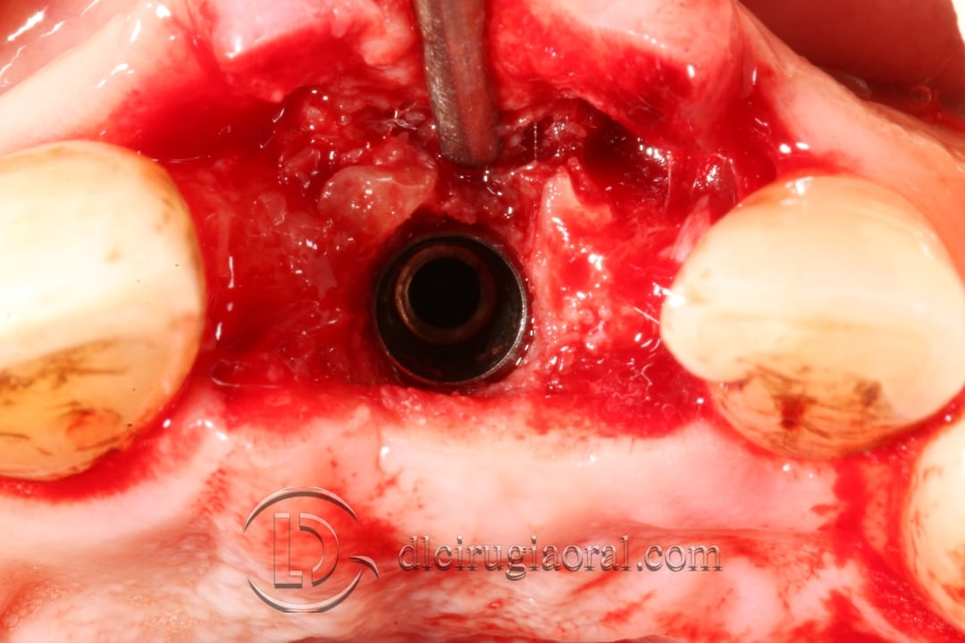 socket preservation in the aesthetic zone