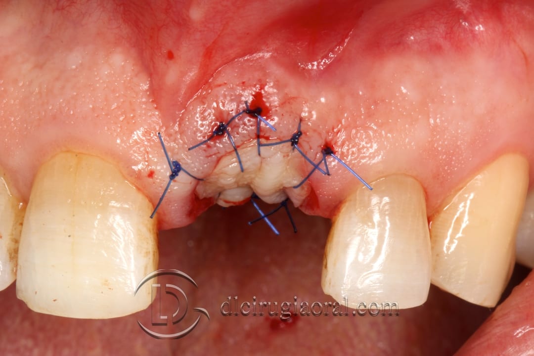 socket preservation in the aesthetic zone
