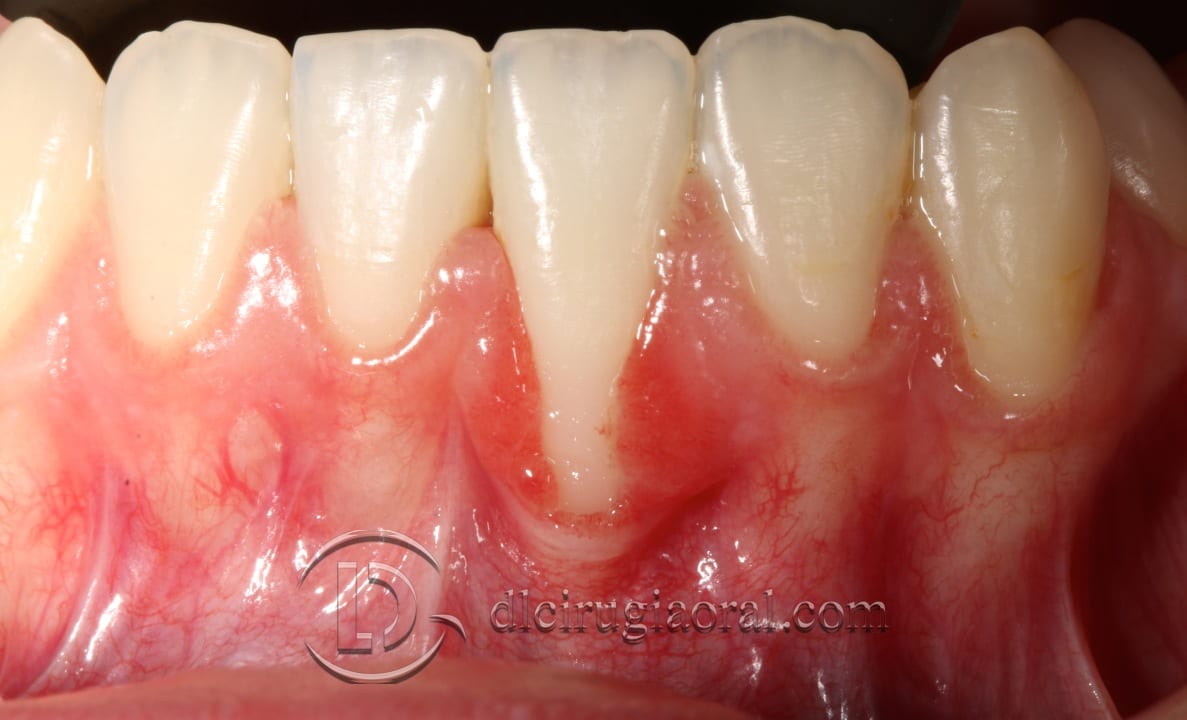 Frenectomy and connective tissue graft – Recession treatment case