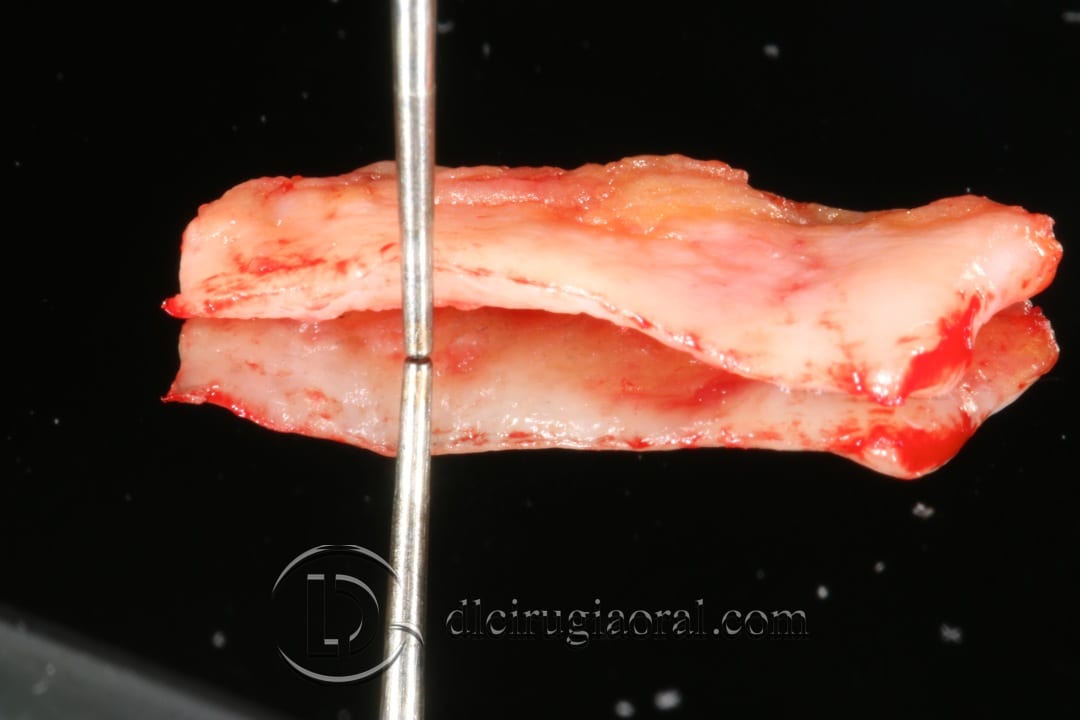 frenectomy and connective tissue graft