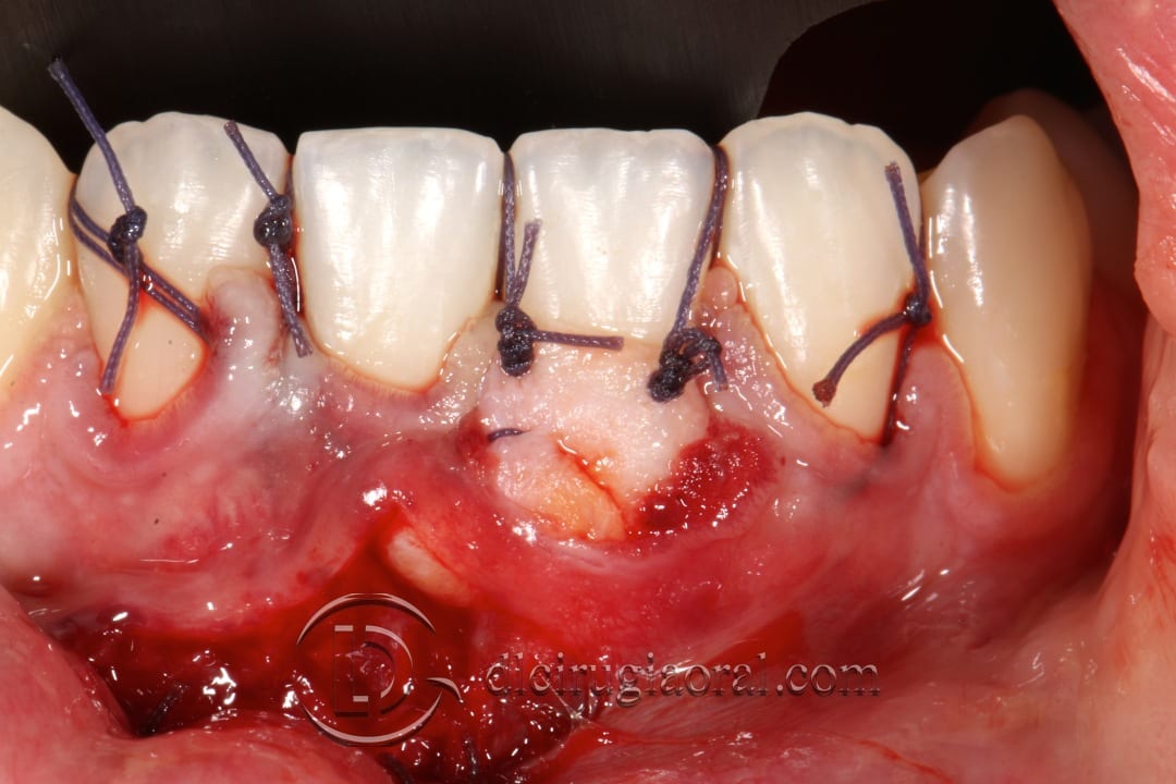 frenectomy and connective tissue graft