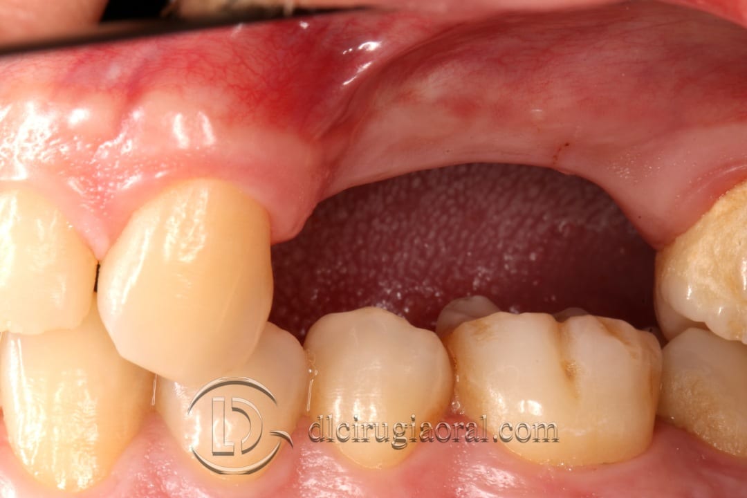 horizontal maxillary gain and implant placement