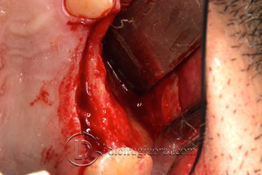 Horizontal maxillary gain and implant placement – Clinical case