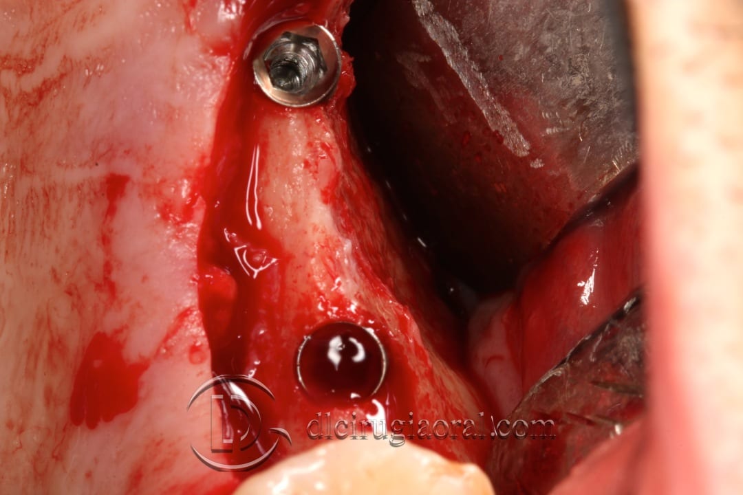 horizontal maxillary gain and implant placement