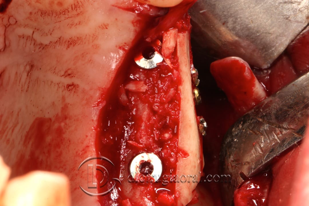 horizontal maxillary gain and implant placement