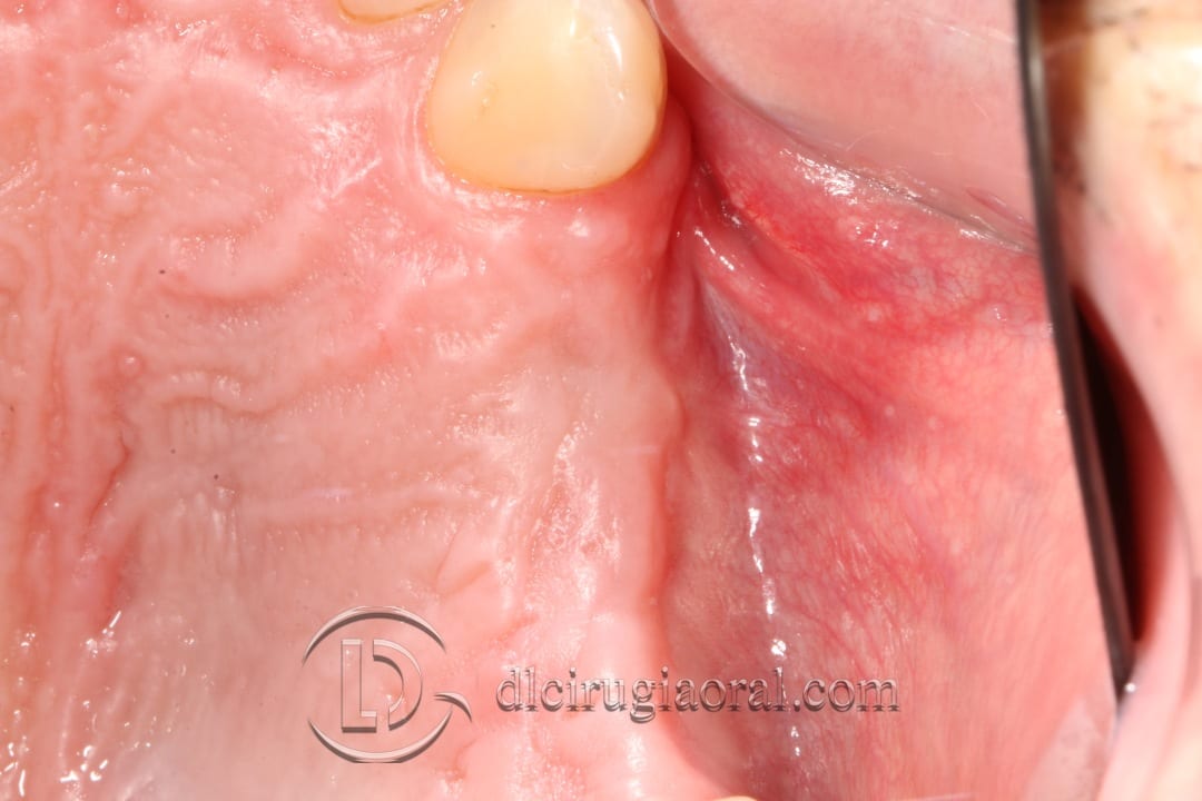 horizontal maxillary gain and implant placement