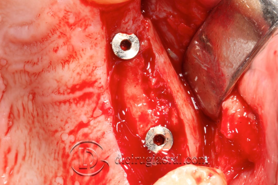 horizontal maxillary gain and implant placement
