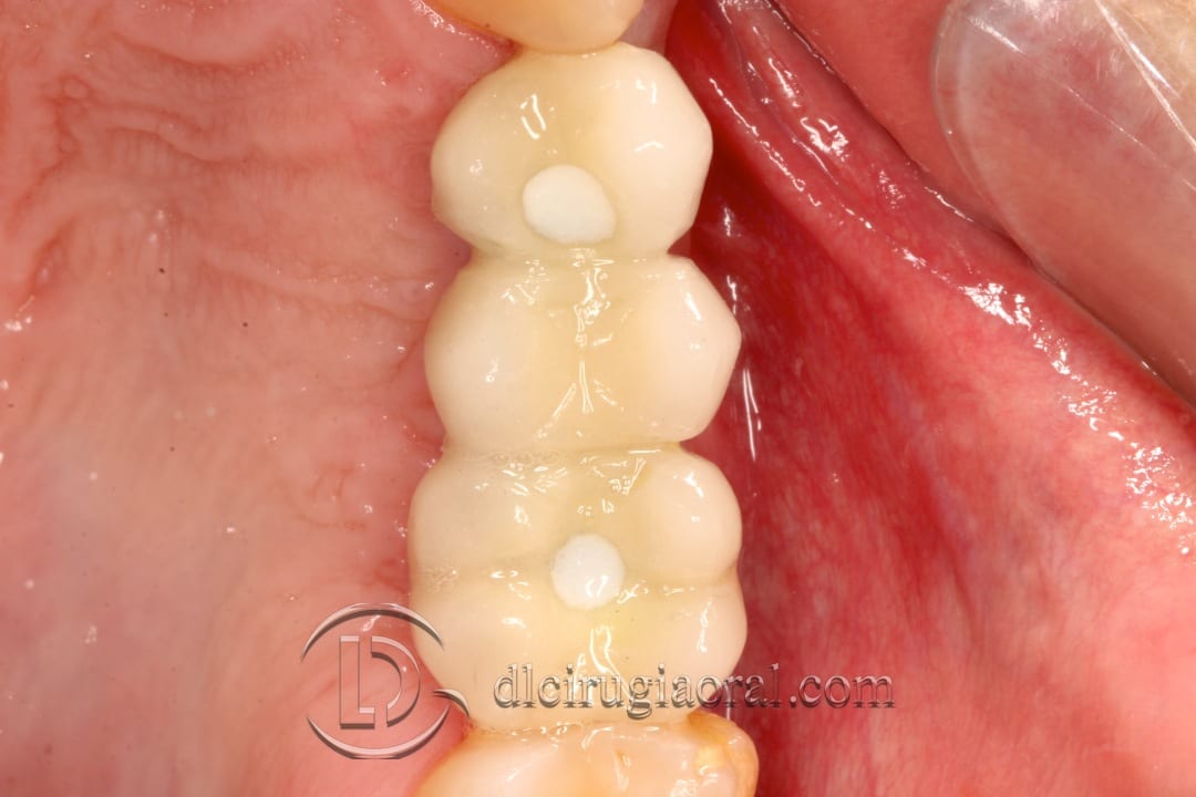 horizontal maxillary gain and implant placement