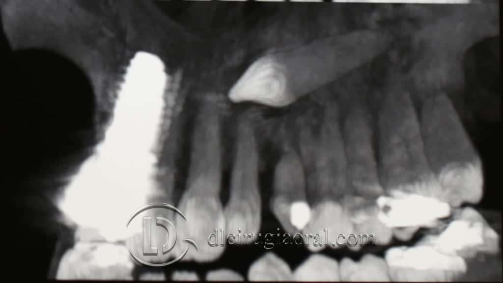 Impacted canine extraction and implant – Single-step approach