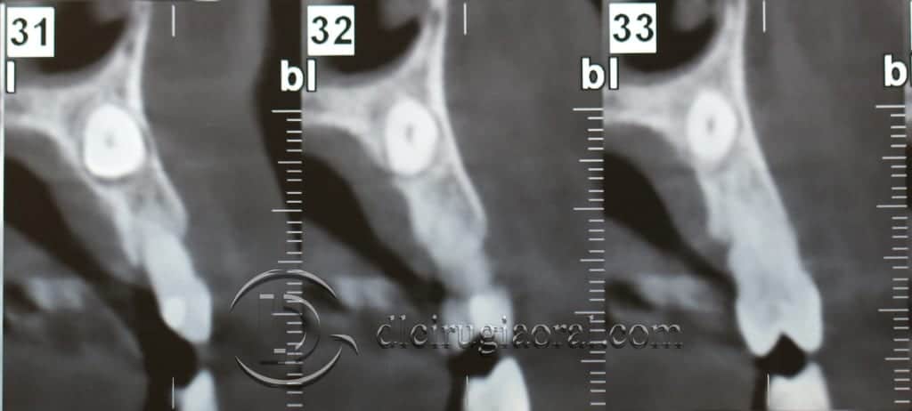 impacted canine extraction and implant