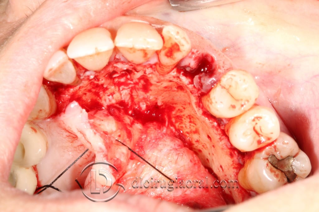 impacted canine extraction and implant
