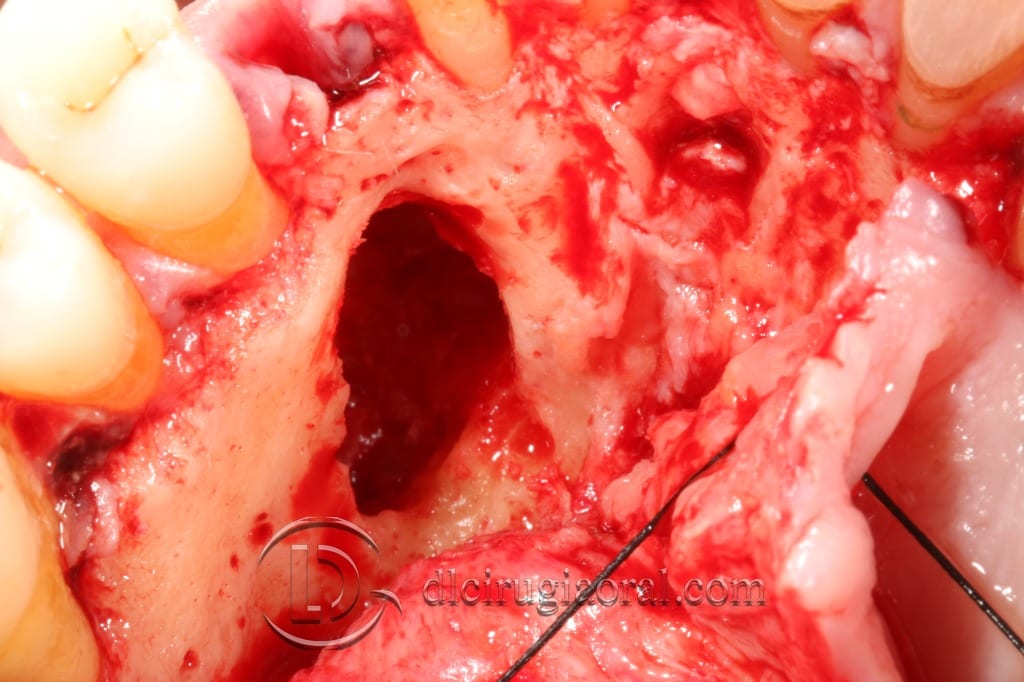 impacted canine extraction and implant