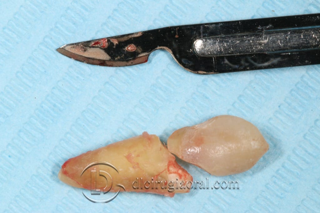 impacted canine extraction and implant