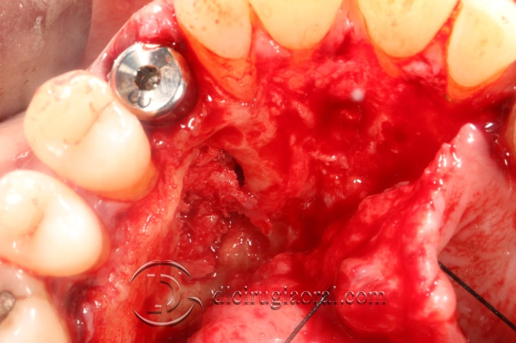 impacted canine extraction and implant