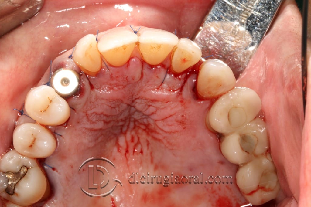 impacted canine extraction and implant