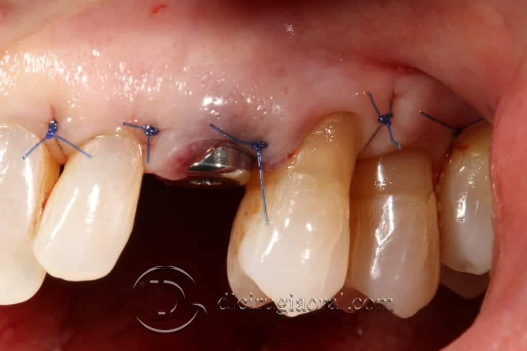 impacted canine extraction and implant