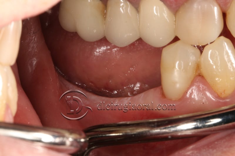 vertical bone augmentation with the Khoury technique