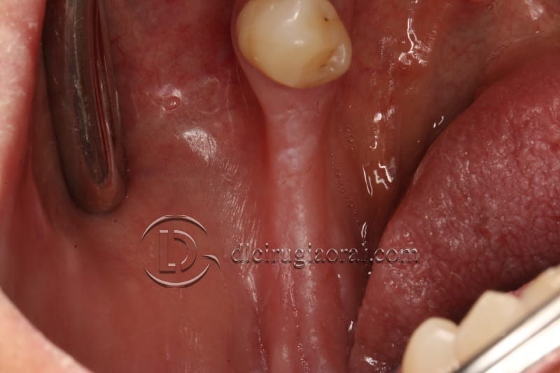 vertical bone augmentation with the Khoury technique