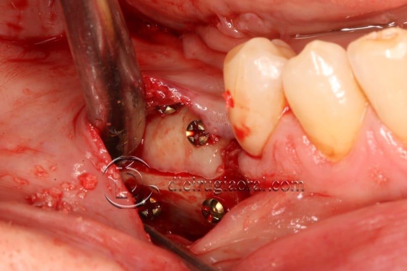 vertical bone augmentation with the Khoury technique