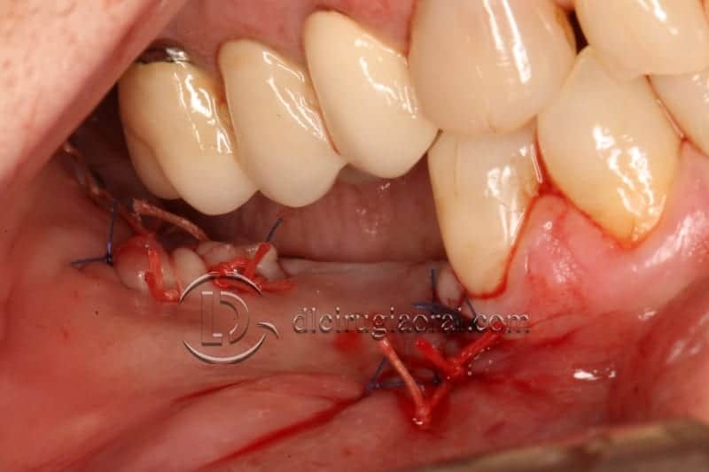 vertical bone augmentation with the Khoury technique