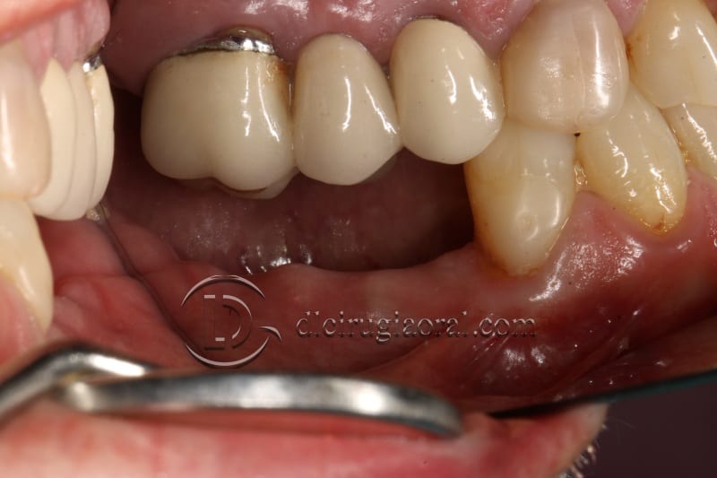 vertical bone augmentation with the Khoury technique