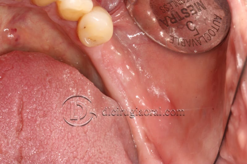 vertical bone augmentation with the Khoury technique