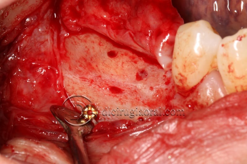 vertical bone augmentation with the Khoury technique